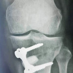 osteotomie-tibiale-chirurgie