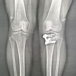 Ostéotomie tibiale de valgisation