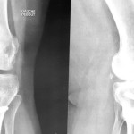 osteotomie-tibiale-radiographie-chirurgie-paris-tunis