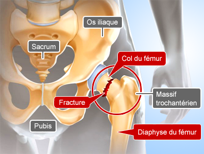 Fracture col du fémur chirurgie orthopédique Paris Tunisie