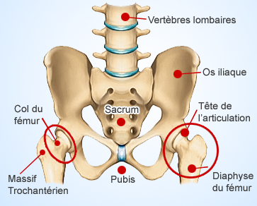 Fracture col du fémur chirurgie orthopédique Paris Tunisie