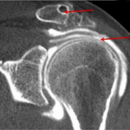 arthro-scanner-de-l-epaule-paris-tunisie