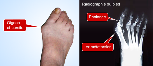 chirurgie-paris-hallux-valgus-gros-orteil-oignon