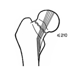 fracture-col-femur-complete-avec-deplacement-partiel-en-coxa-vara