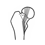 fracture-femur-engrenee-en-coxa-valga