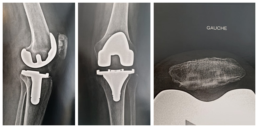 Prothèse totale anatomique du genou dans le cadre d'une arthrose associée à une ostéoporose tibiale.
