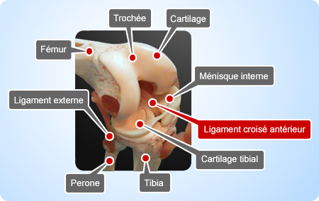 Ruptures du ligament croisé antérieur du genou Paris Tunisie