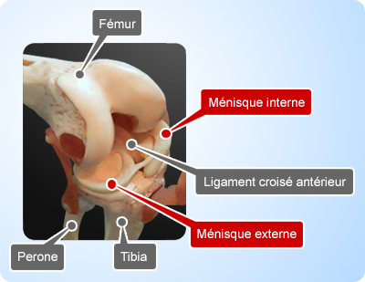 Chirurgie ménisques du genou par arthroscopie Paris Tunisie