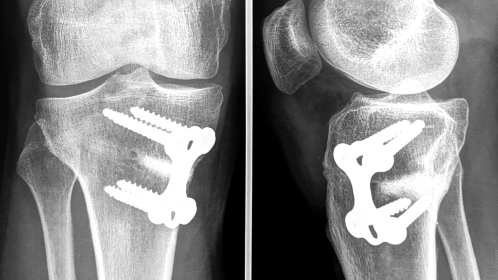 Ostéotomie tibiale de valgisation - Chirurgie du genou Paris