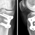 chirurgie-genou-correction-deformation-du-genou-paris-osteotomie-tibiale-dr-kassab