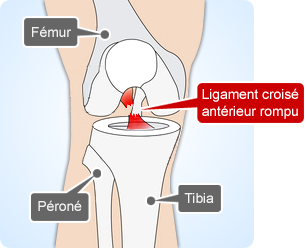 Ruptures du ligament croisé antérieur du genou Paris Tunisie
