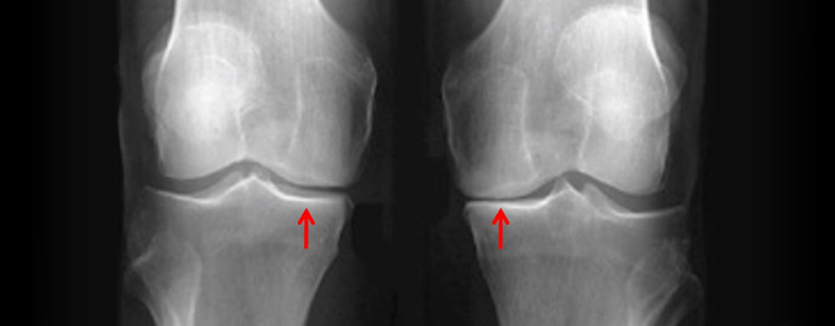 osteotomie-tibiale-chirurgie-genou-paris