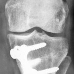 osteotomie-tibiale-face-profil