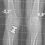 pangonogramme-osteotomie-tibiale