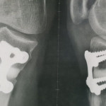 radiographie-osteotomie-tibiale-paris