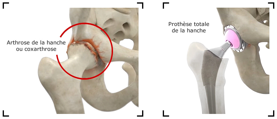 arthrose-hanche-coxarthrose-traitement-chirurgical-prothese-de-hanche
