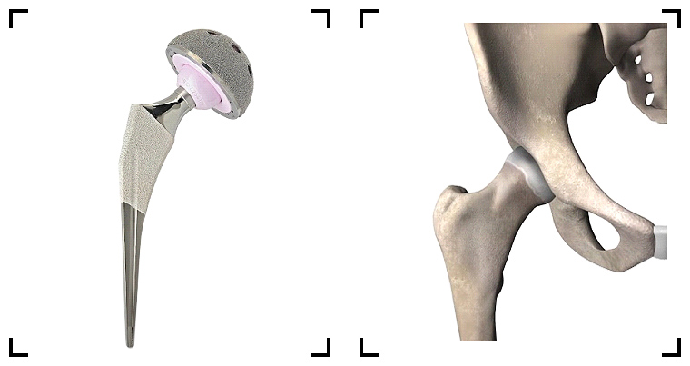 chirurgie-prothese-totale-de-la-hanche-paris